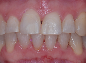 After Treatment